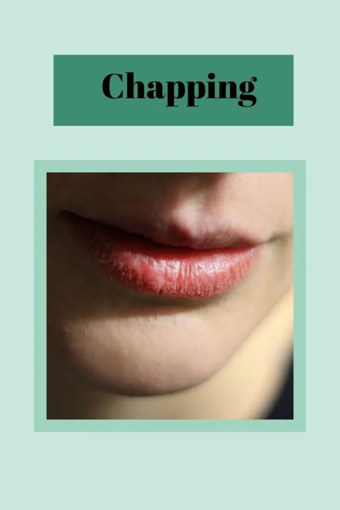 Some girl is showing her chapped lips Some girl is showing her chapped lips - Lip care