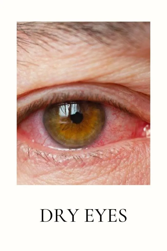 A red dry eye is shown in image A red dry eye is shown in image - dry eyes