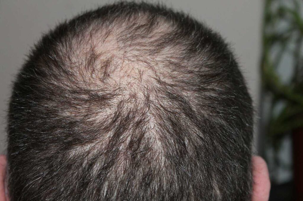 Hair Loss Causes – Diseases and Conditions [Male & Female]