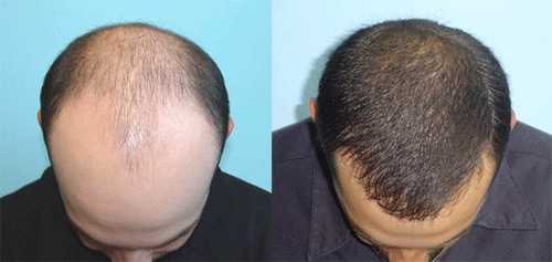 Hair Transplant Procedure, Average Cost, Risk, and Treatment