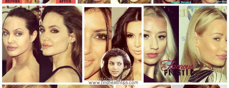 Top Celebrities who have Done Plastic Surgery