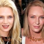 Uma Thurman before and after plastic surgery
