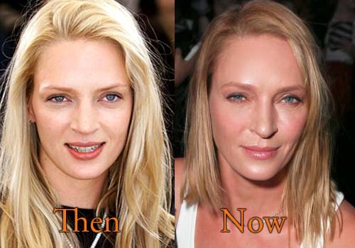 Uma Thurman before and after plastic surgery