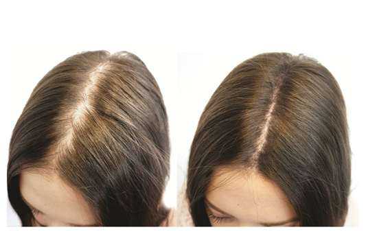 hair regrowth before and after
