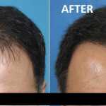 Stem cell Hair Treatment
