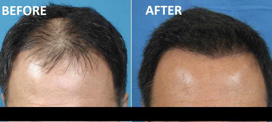 Stem cell Hair Treatment