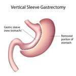 gastric weight loss surgery