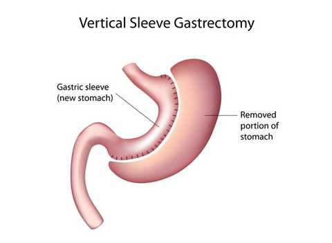 gastric weight loss surgery