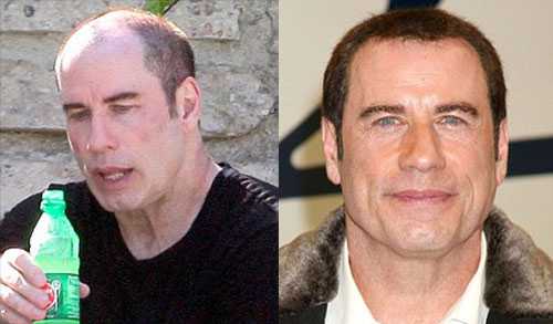 balding-treatment