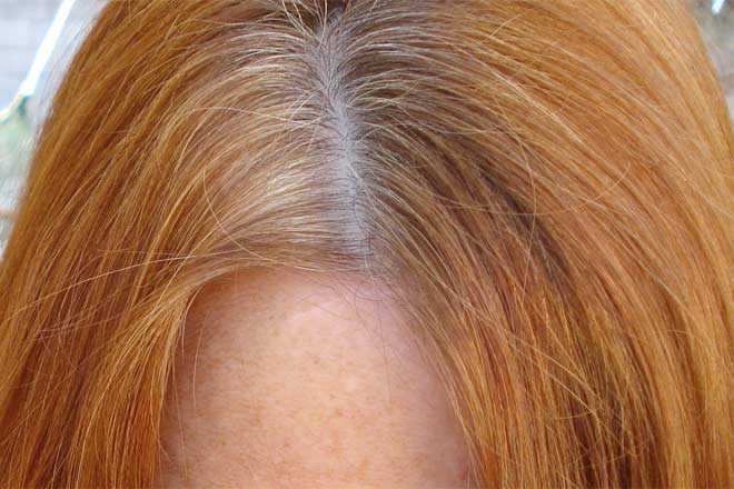 flaky scalp