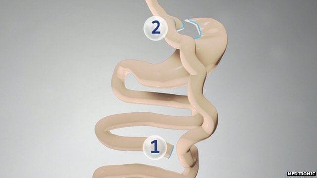 Bariatric Surgery Works