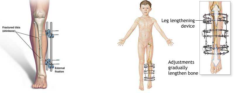 Height Increasing Surgery – Limb Lengthening Surgery | TecHutch.com