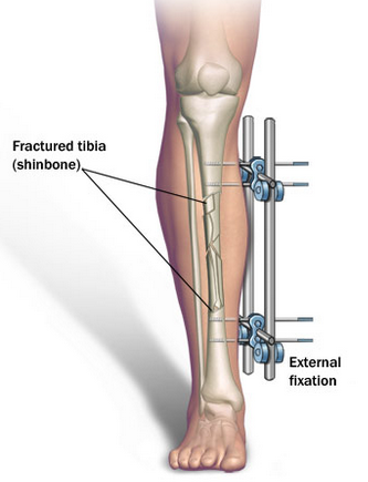 Implantes sin cirugía en los talones. Máximo 4cm - Página 2 Limb-Lengthening-Surgery