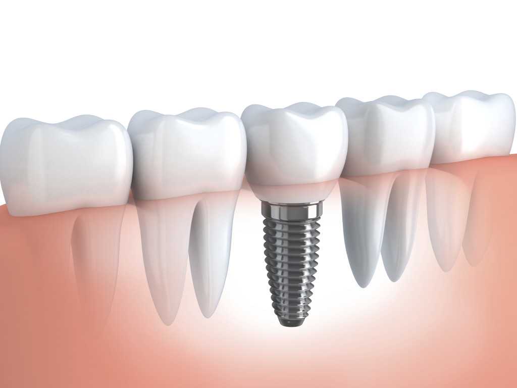 [Sponsored Post] – Guide of Dental Implants