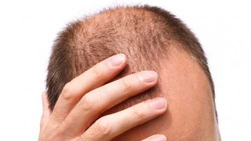 Get Rid of Baldness with Hair Vitamins Supplements