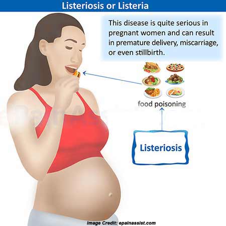 listeriosis