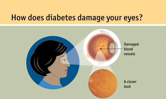 diabetes eye problem