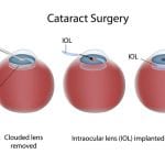lasik cataract surgery