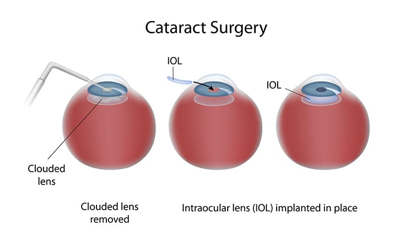LASIK and Cataracts – Cataracts after LASIK Eye Surgery