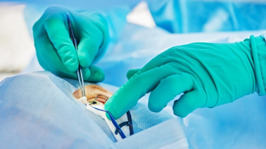 lasik eye surgery information