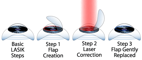 Laser & Lasik Eye Surgery Guide – How It Works, Cost, & Risks
