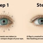 vision correction surgery