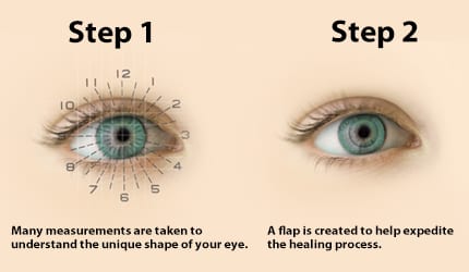 vision correction surgery