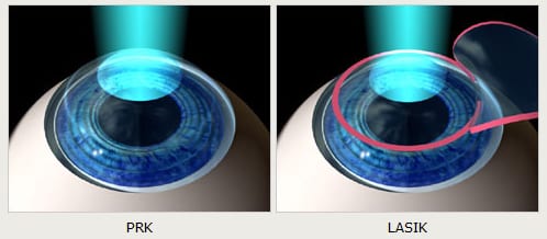 PRK vs. LASIK. Why is PRK right for you?