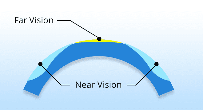 Presbyopia Eye Surgery