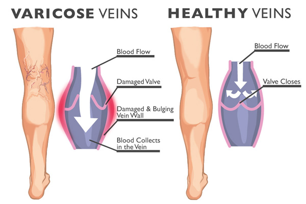 Menopause and How it Relates to Varicose Veins