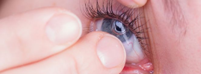 contact lens intolerance
