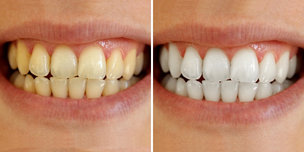 Top 5 Teeth Whitening Products in India 2017