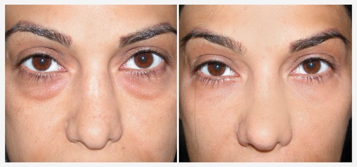 Top 5 Dark Circle Reducing Creams Available In India