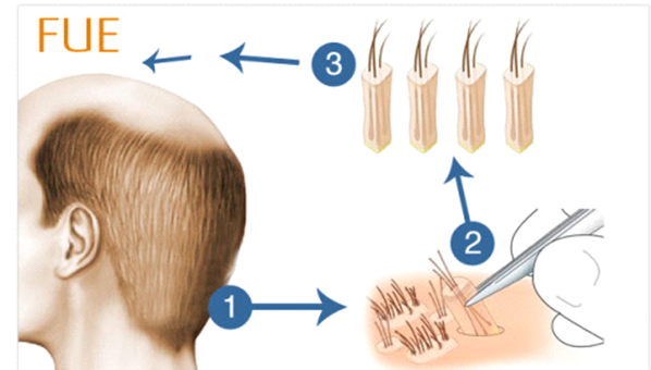 fue hair transplant 