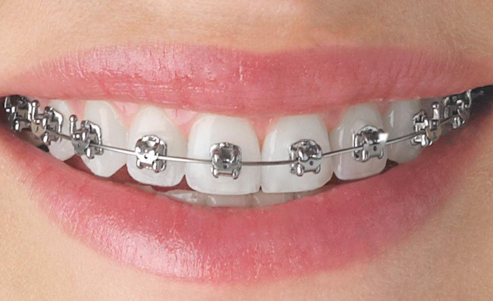 braces braces