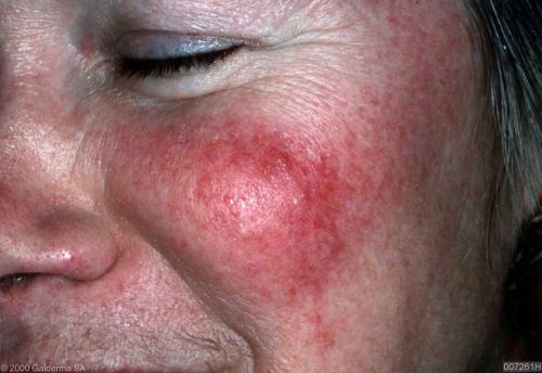 rosacea