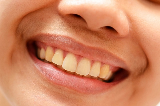 yellow teeth causes