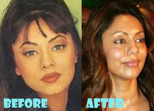 Gauri Khan Plastic Surgery