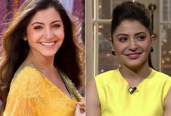 Anushka Sharma Bollywood Actress Plastic Surgery