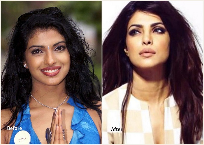 Priyanka Chopra before and after pics of cosmetic surgery - bollywood cosmetic surgery revealed