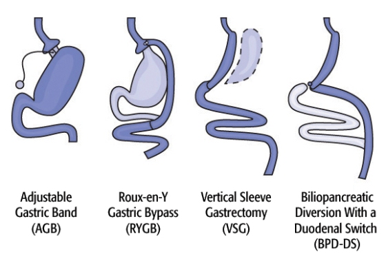 bariatric surgery centers germany