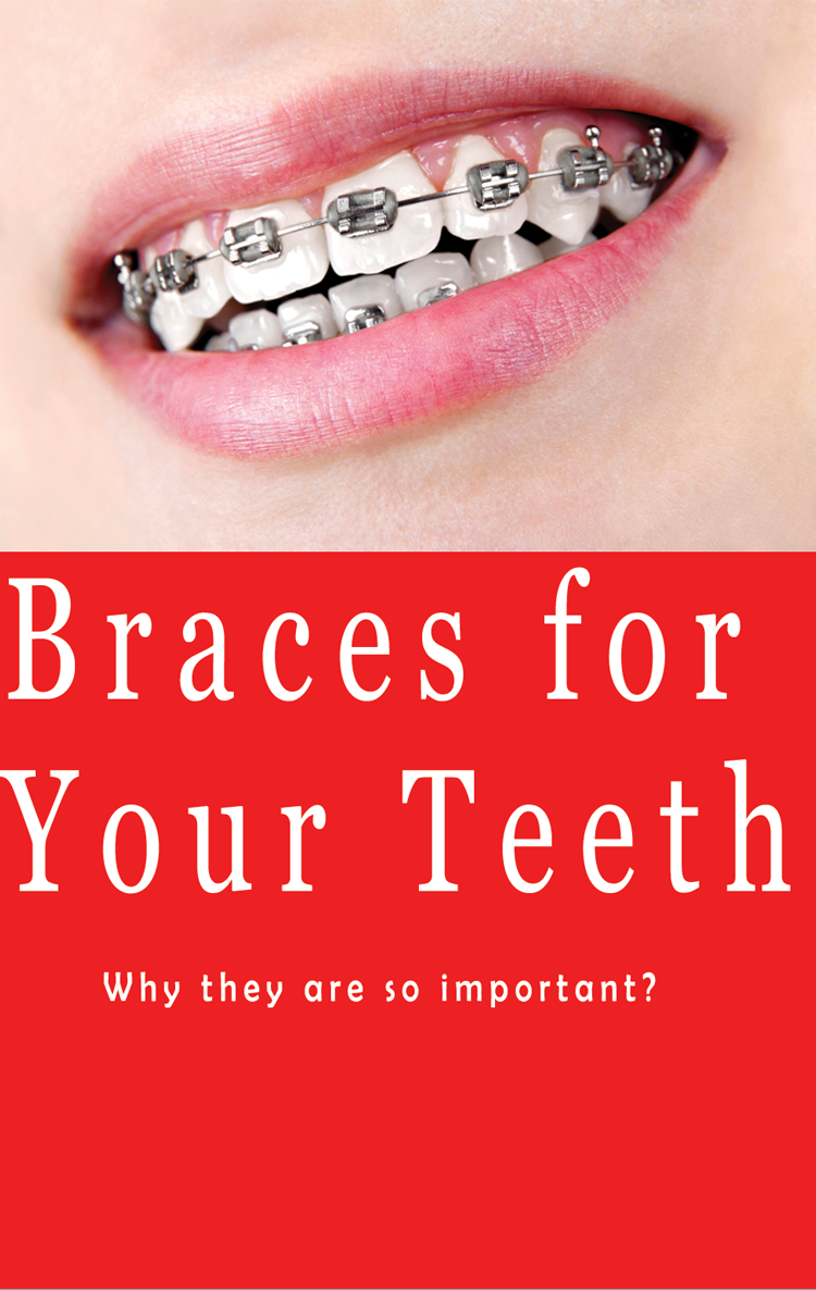 braces for your teeth