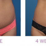 coolsculpting how it works