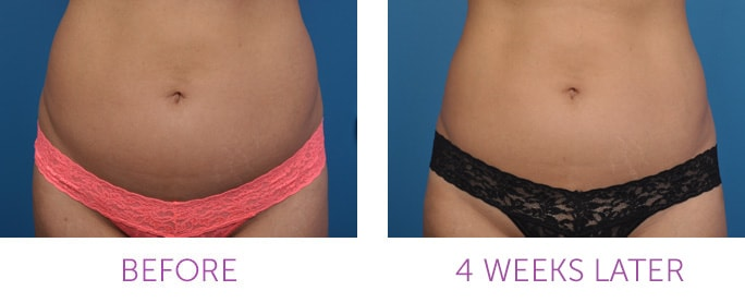 coolsculpting how it works