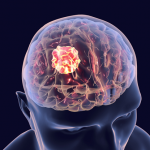 brain tumor prevention
