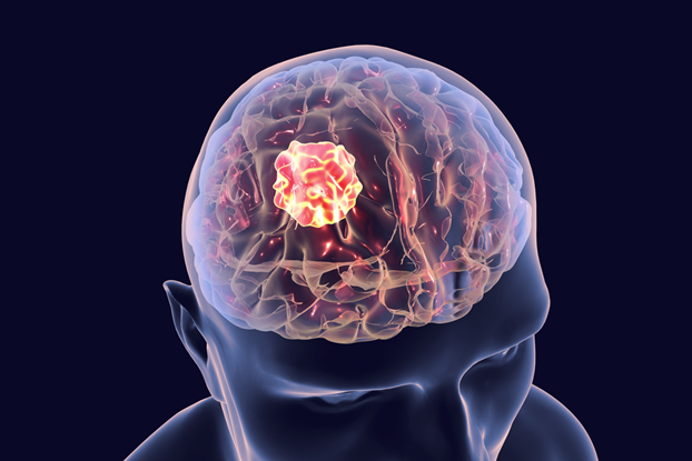 brain tumor prevention