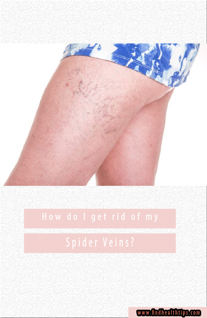How Do I Get Rid of My Spider Veins?