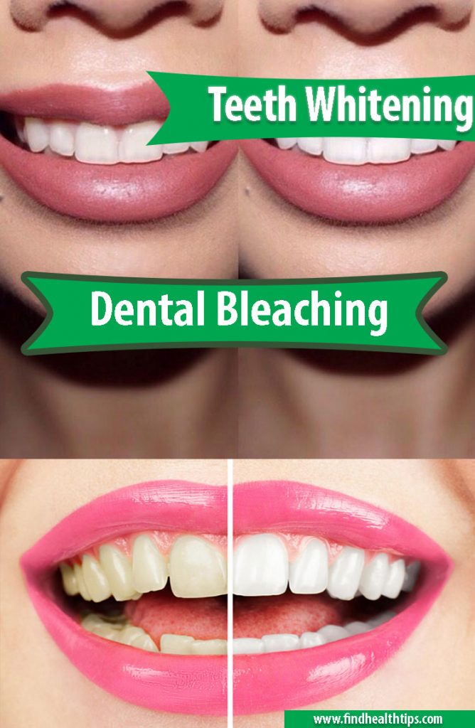 Dental Bleaching Done Right by the Dentist