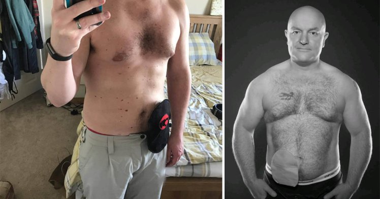 Living with an Ostomy 1