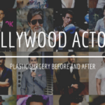 bollywood actors surgery before after